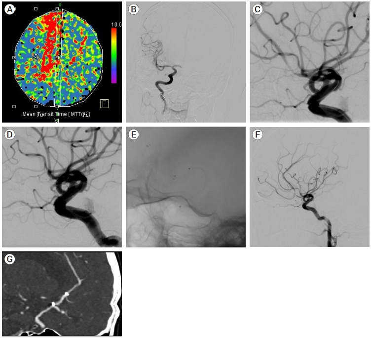 Prognostic factors for reocclusion after mechanical thrombectomy plus rescue treatment in acute athereosclerotic steno-occlusion with successful recanalization.