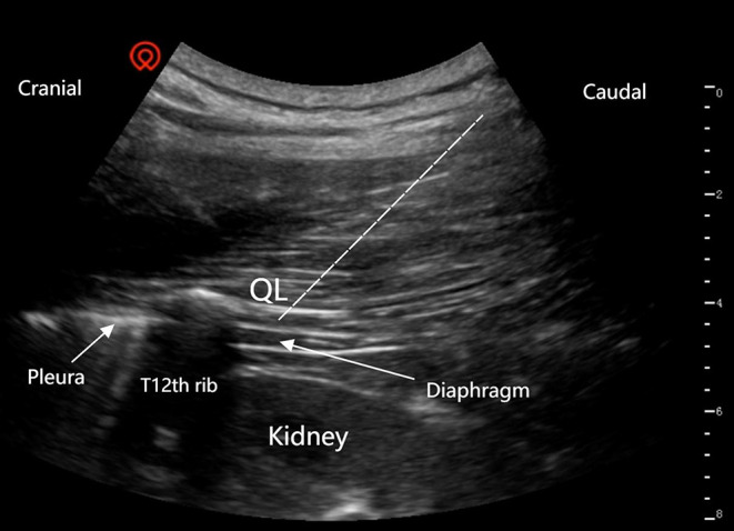 Liposomal Bupivacaine for Quadratus Lumborum Block at the Lateral Supra-Arcuate Ligament in the Analgesic Effect After Laparoscopic Nephrectomy: A Single-Centre, Triple-Blind, Randomized Controlled Trial.