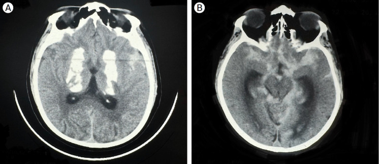 A rare case of Fahr's disease with posterior circulation (basilar tip) aneurysm- pathophysiology, management, and complications.