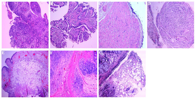 CT-Occult Primary Benign Tracheobronchial Neoplasms: A Single-Center 40-Case Clinicopathologic Series.