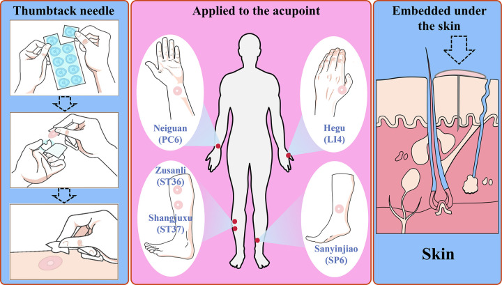Effect of the thumbtack needle on gastrointestinal function recovery after laparoscopic radical gastrectomy for gastric cancer with the concept of enhanced recovery after surgery: a randomized controlled trial.
