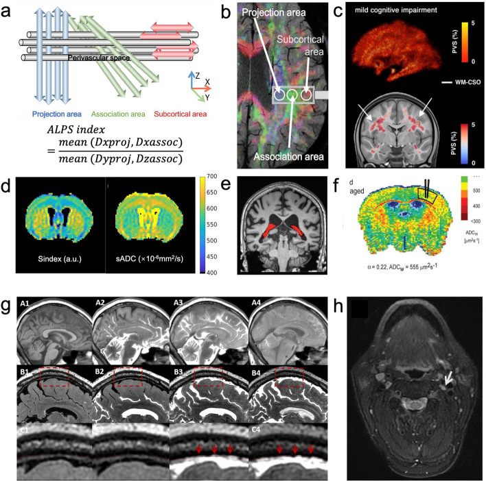 Targeting the glymphatic system: Aβ accumulation and phototherapy strategies across different stages of Alzheimer's disease.