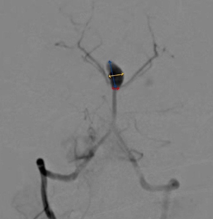 A rare case of Fahr's disease with posterior circulation (basilar tip) aneurysm- pathophysiology, management, and complications.