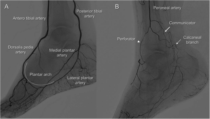 Efficacy and safety of Trans-collateral revascularization of infrapopliteal vessels: A Single-center retrospective study.