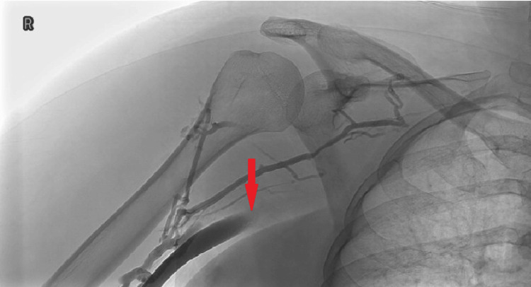 An Unusual Presentation of Paget-Schroetter Syndrome: A Reminder on the Importance of Clinical Judgment.