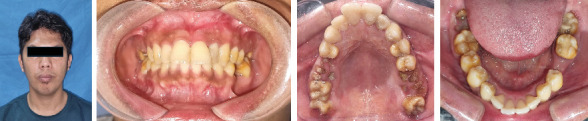 Combination of Platelet-Rich Fibrin and Carbonate Hydroxyapatite for Bone Regeneration in the Management of Radicular Cyst: A Case Report.
