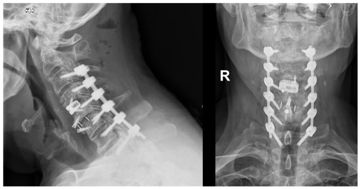 Accuracy of Navigated High-Speed Drill-Assisted Cervical and Upper Thoracic Pedicle Screw Placement-A Single Center Experience with 1112 Pedicle Screws.