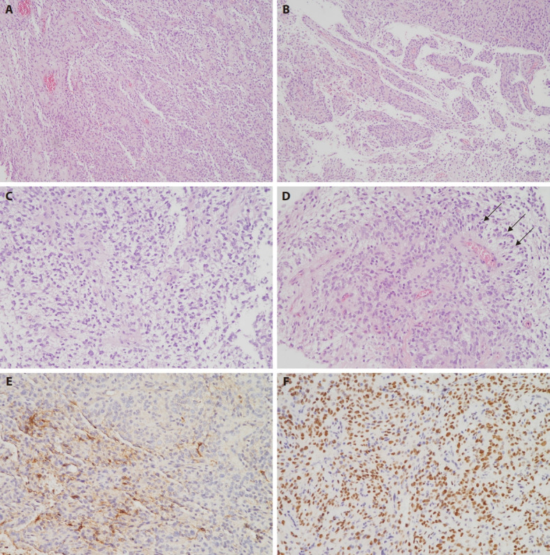 Central nervous system tumors with BCOR internal tandem duplications: a systematic review of clinical, radiological, and pathological features in 69 cases.