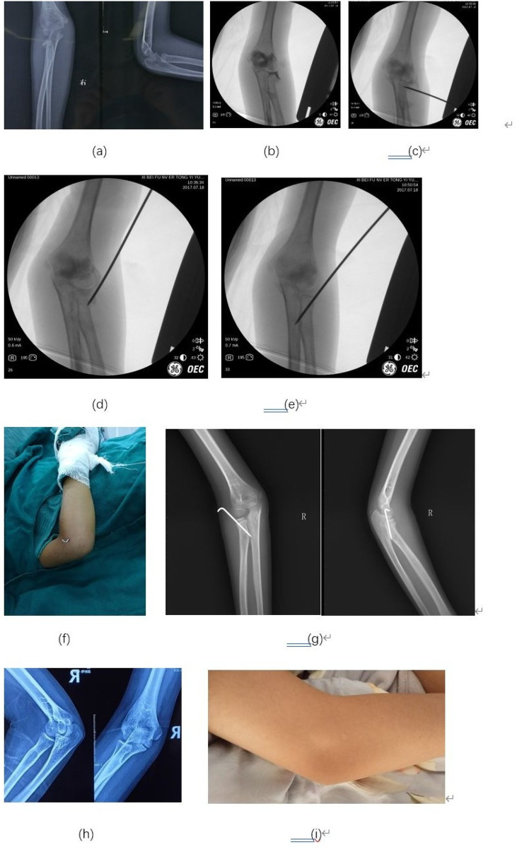 Percutaneous leverage reduction with kirschner-wire fixation assisted by elbow arthrography for pediatric radial neck fractures.