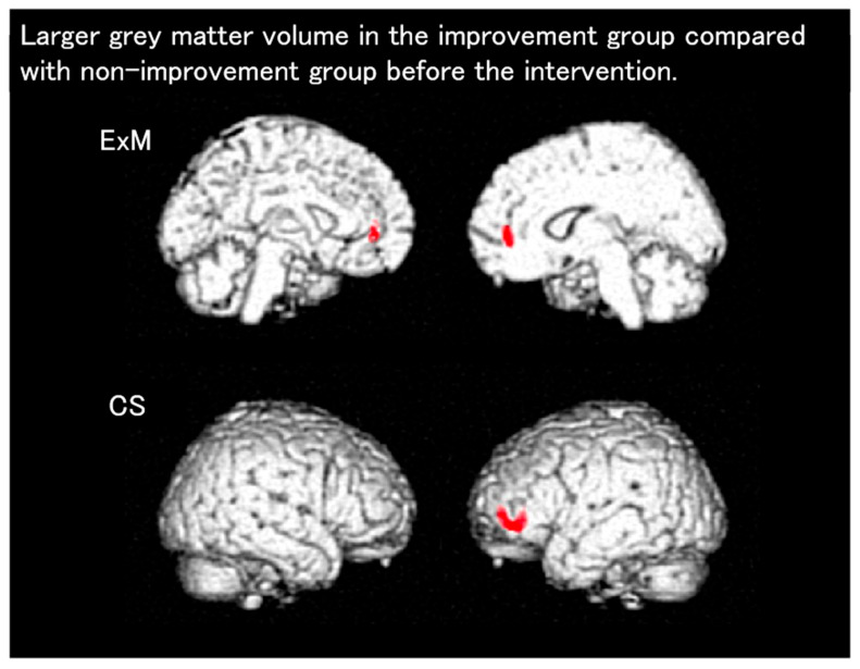 Statistical Parametric Mapping and Voxel-Based Specific Regional Analysis System for Alzheimer's Disease (VSRAD): Principles and Clinical Applications.