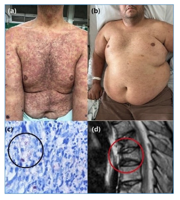 Managing leprosy reactions with secukinumab: Insights from a case series.