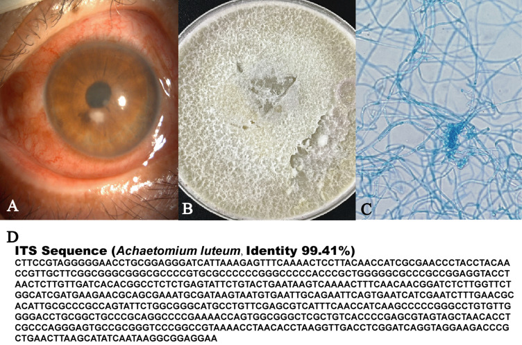 <i>Achaetomium luteum</i> and <i>Exserohilum rostratum</i>, Two Rare Causes of Keratomycosis in China: Case Report.