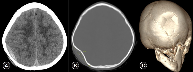 Successful minimally invasive reduction surgery with a micro burr hole in a pediatric patient with depressed skull fracture: a case report.