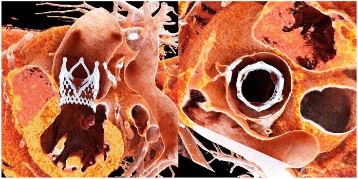 Editorial: Reviews in transcatheter aortic valve implantation.