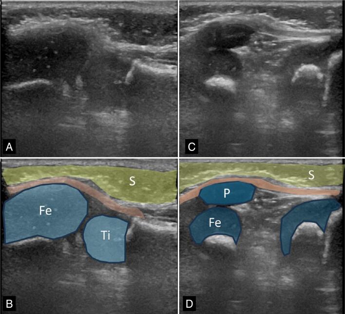 ULTRASONOGRAPHY OF THE CARTILAGINOUS PATELLA IN PEDIATRIC PATIENTS: A CASE SERIES.