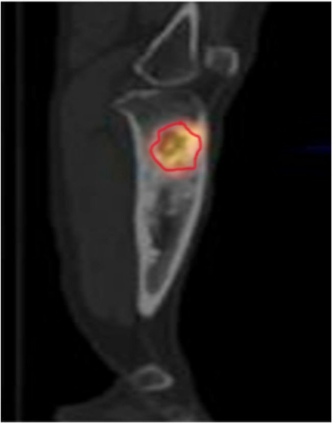 Study of the extent of surgical osteotomy in Cierny-Mader stages III and IV chronic osteomyelitis.