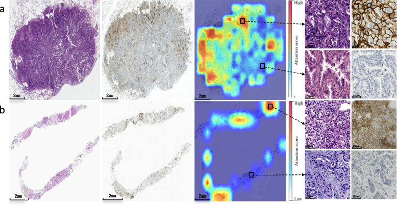 Artificial Intelligence-driven image analysis for standardised programmed death-ligand 1 expression evaluation in non-small cell lung cancer.