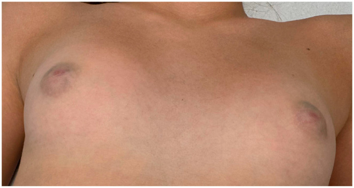 Bluish-Green Coloration of the Nipples: A Diagnostic Clue for Retroareolar Cysts.