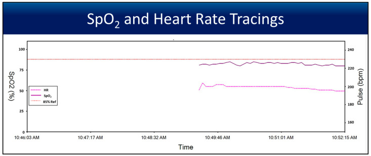 The Utility of Umbilical Cord Pulse Oximetry-A Translational Study with Four Minutes of Deferred Cord Clamping Using an Asphyxiated Preterm Ovine Model.