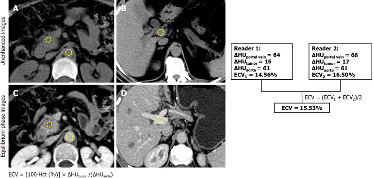 Preoperative risk stratification of early recurrence in resected pancreatic ductal adenocarcinoma: Novel equilibrium-phase-computed tomography biomarker of extracellular volume.