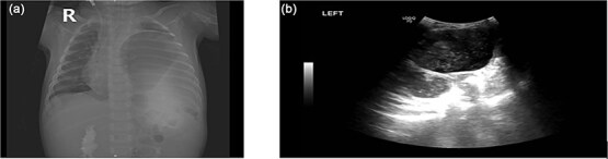 Tension gastrothorax in a late-presenting congenital diaphragmatic hernia: a case report and review of the literature.