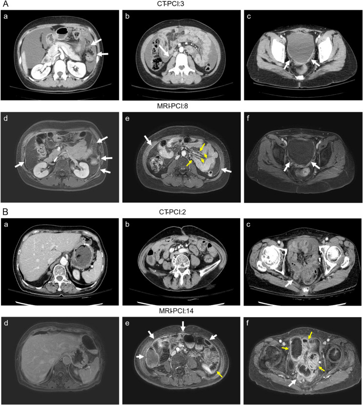 Real-world risk factors for incomplete cytoreduction in peritoneal carcinomatosis patients scheduled for cytoreductive surgery and hyperthermic intraperitoneal chemotherapy.