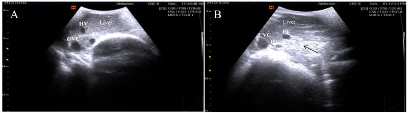 Genomic Variants, Transcriptomic Profile, Ultrasonographic Findings, and Antioxidant and Immunological Biomarkers Linked to Pregnancy Toxemia Susceptibility in Goats.