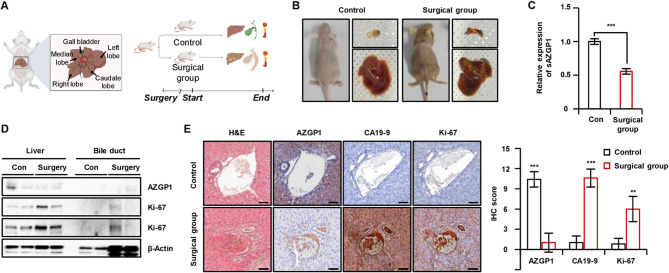 Secreted AZGP1 induced by 5-FU binds to PD-L1 and promotes apoptosis in cholangiocarcinoma.