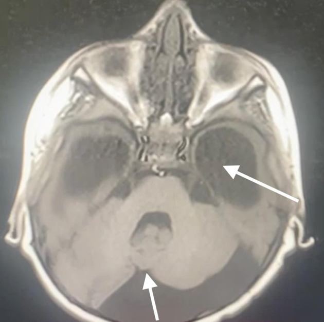 Anesthesiologist's Concerns About Dandy-Walker Syndrome: Airway Management, Muscle Relaxants, and Train-of-Four Monitoring of Neuromuscular Blockade.