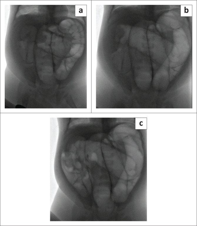 Risk factors associated with the outcomes of fluoroscopy guided pneumatic enema reductions of intussusceptions.