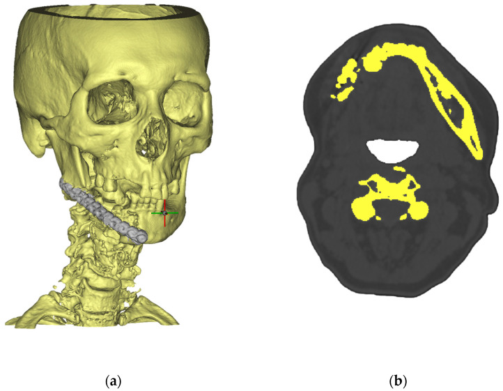 Data-Driven Design and Additive Manufacturing of Patient-Specific Lattice Titanium Scaffolds for Mandibular Bone Reconstruction.