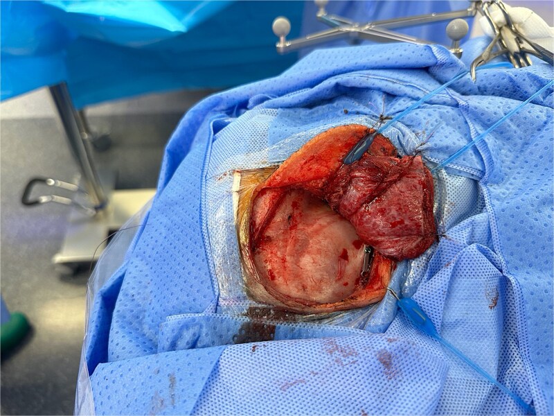 Multidisciplinary management of intracranial migration of a fractured dental needle through the foramen ovale: a case report.