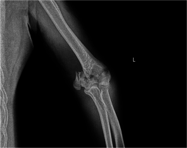 Comparison of parallel and orthogonal plating techniques and the predictive role of Hounsfield unit values in AO/OTA type 13-C distal humerus fractures in patients over 50.
