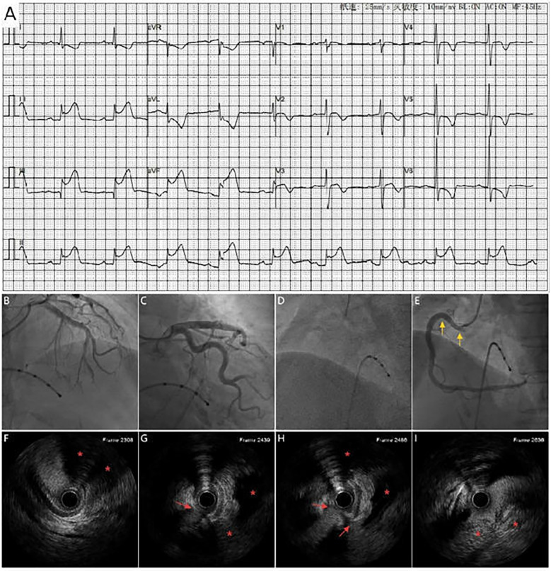 When the culprit lies outside the coronary artery: dual case report of coronary sinus of valsalva dissection presenting as STEMI.