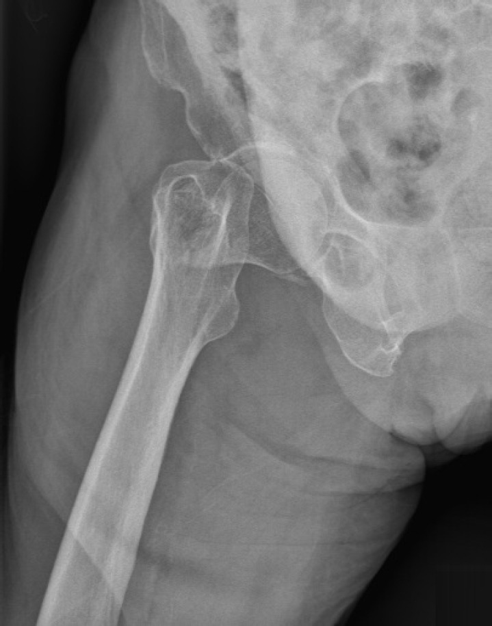 The SPAIRE (saving piriformis and internus, repair of externus) posterolateral approach in bipolar hemiarthroplasty for femoral neck fractures: a case report.
