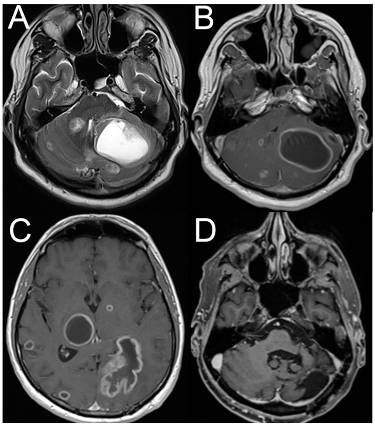 Acute Vertigo, Dizziness and Imbalance in the Emergency Department-Beyond Stroke and Acute Unilateral Vestibulopathy-A Narrative Review.