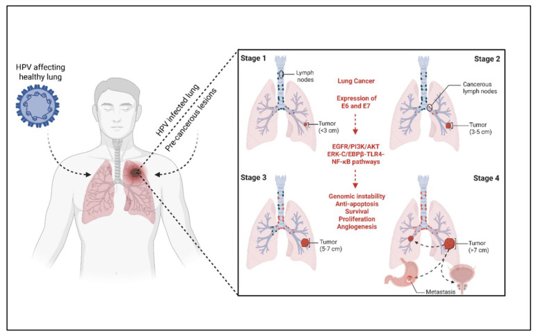 Emerging Therapeutic Strategies for Lung Cancer: The Role of Immunotherapy and HPV-Targeted Cancer Vaccines.