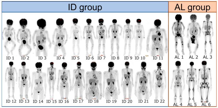 Unique Bone Marrow Findings of FDG-PET/CT in Acute Leukemia in Children: Comparison to Inflammatory Diseases.