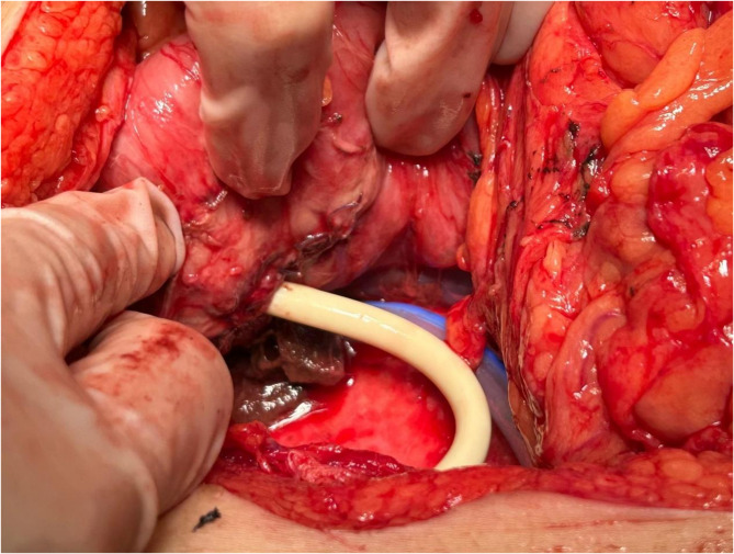 The submission title: management of retroperitoneal perforated descending duodenal diverticulum using de pezzer catheter drainage combined with nutritional jejunostomy: a case report and review of the literature.