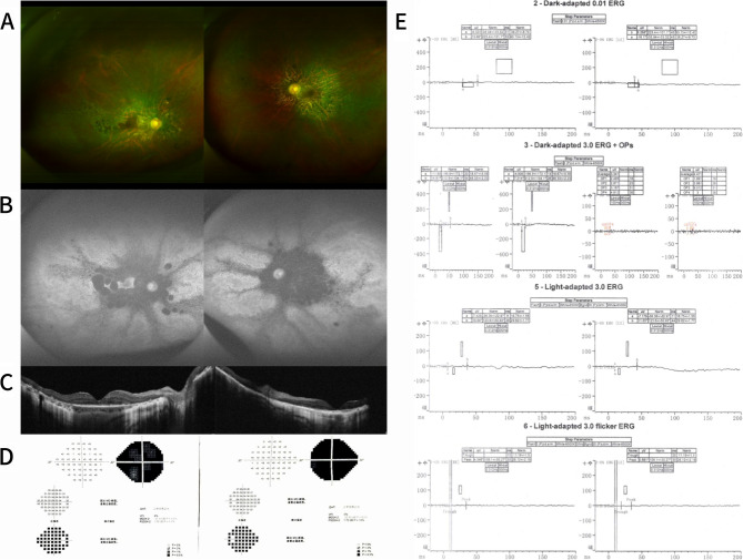 Autoimmune retinopathy in patients with myasthenia gravis: cases series and literature review.