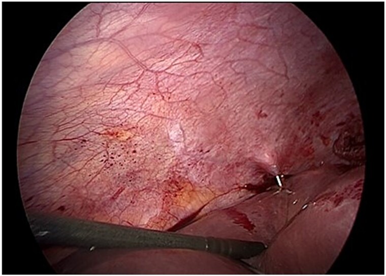 Laparoscopic management of a Gharbi type II hepatic hydatid cyst after failed pair.