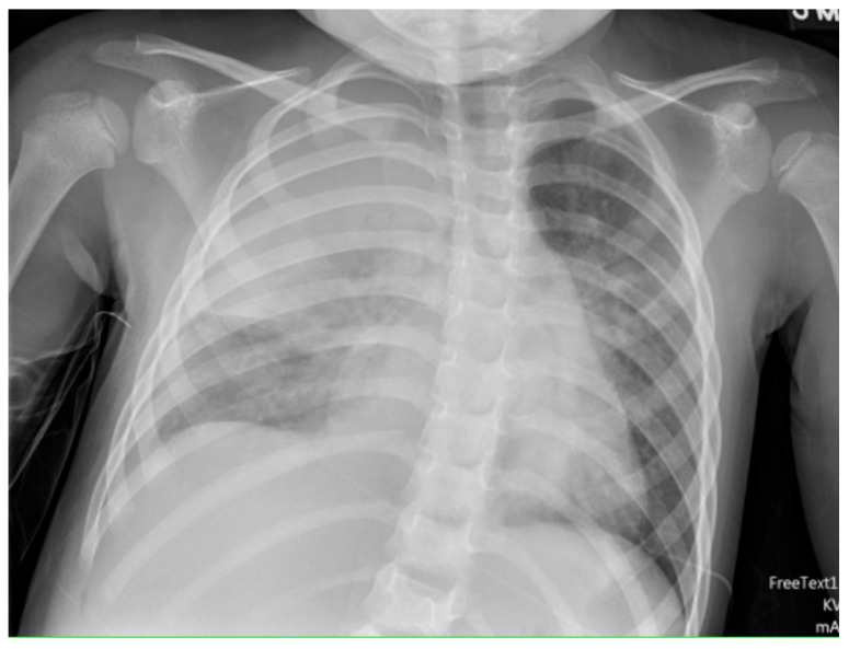 A Comprehensive Review of Pediatric Necrotizing Pneumonia.