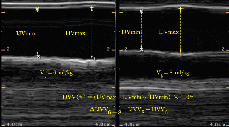 Changes in internal jugular vein respiratory variation during tidal volume challenge predict volume responsiveness in lumbar surgery under protective ventilation: a prospective cohort study.