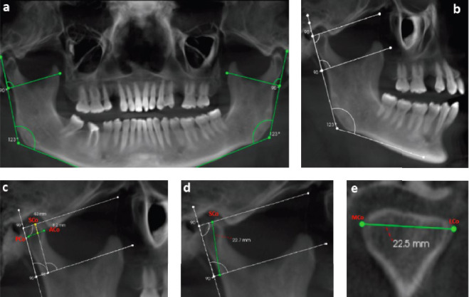The Combined Impact on Condylar Changes of Sex and Cortication on Mandibular Condyle: A Binary Logistic Regression Analysis.
