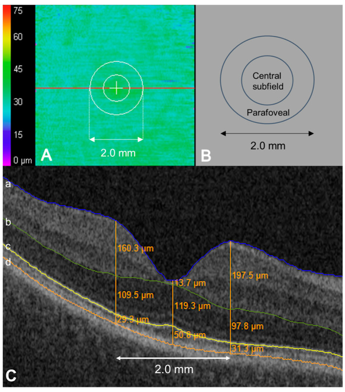 Longitudinal Ellipsoid Zone Dynamics During Hydroxychloroquine Use.