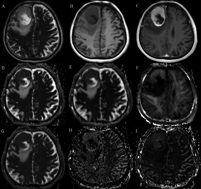 Whole-tumor histogram analysis of diffusion weighted imaging, diffusion kurtosis imaging, and intravoxel incoherent motion for adult diffuse glioma genotyping.