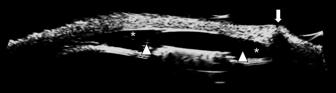 Validation of the EYEMATE-SC Suprachoroidal Pressure Transducer for Telemetric Measurement of Intraocular Pressure in Normal Ex Vivo Canine and Equine Globes-Preliminary Results.