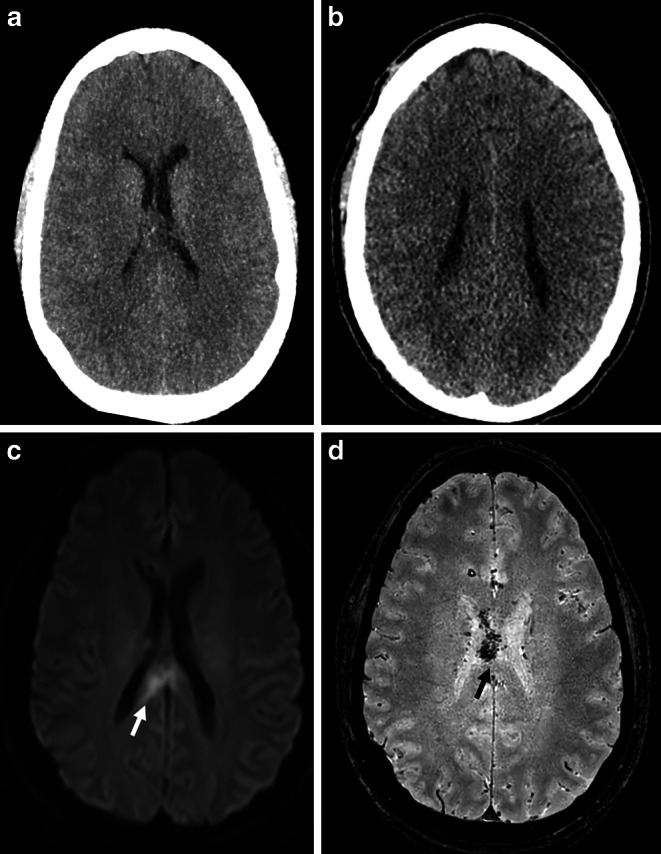 Evaluation of CT and MRI Radiomics for an Early Assessment of Diffuse Axonal Injury in Patients with Traumatic Brain Injury Compared to Conventional Radiological Diagnosis.