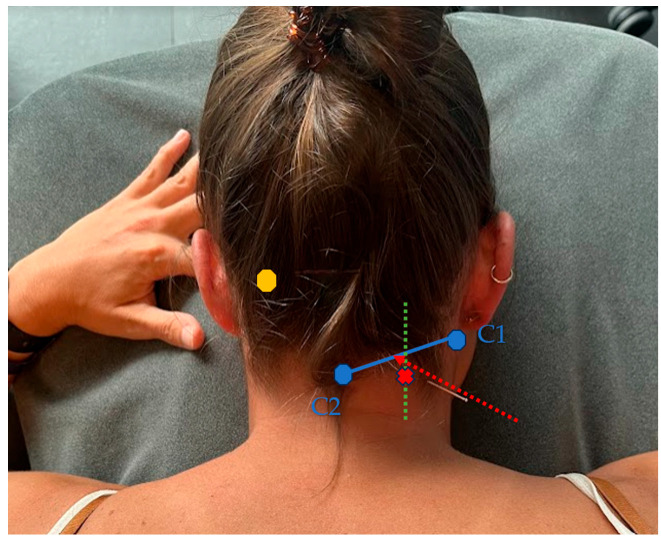 Effects of Dry Needling of the Obliquus Capitis Inferior in Patients with Cervicogenic Headache and Upper Cervical Dysfunction: An Exploratory Randomized Sham-Controlled Trial.