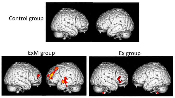 Statistical Parametric Mapping and Voxel-Based Specific Regional Analysis System for Alzheimer's Disease (VSRAD): Principles and Clinical Applications.
